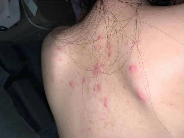 女生背后长痘痘怎么办_海口专治痘痘医院