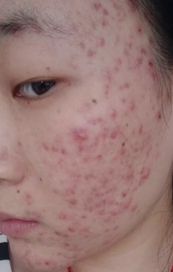 去医院治疗青春痘到底有没有用_海口专治痘痘医院