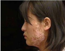 女性患有白癜风平常要怎么护理_海口专科白癜风医院