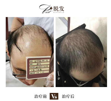 海口治疗脱发哪家正规