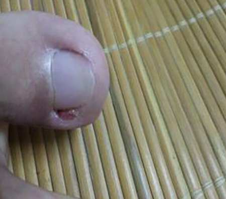 在海口哪家医院治甲沟炎好