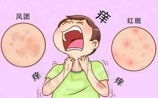 海口皮肤专科医院荨麻疹