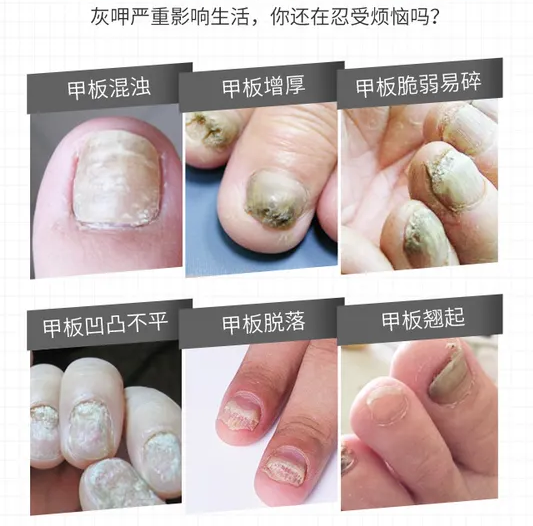 海口看灰指甲什么医院好